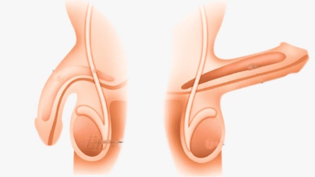 ما هو انحناء العضو الذكري؟