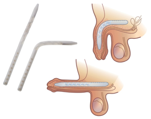ما هي الدعامة المرنة؟