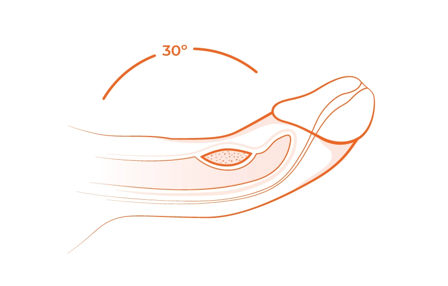 ما هي عملية تصحيح انحناء القضيب؟