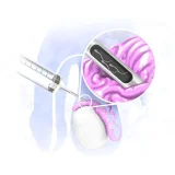 عملية عينة خصية