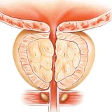 الم في الخصية اليمنى